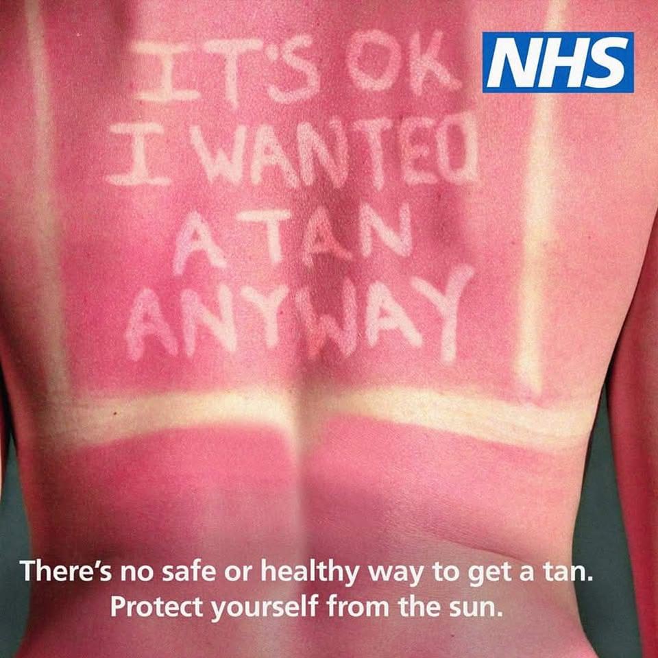 sunburn